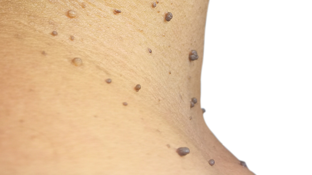Woman's neck with skin tags 