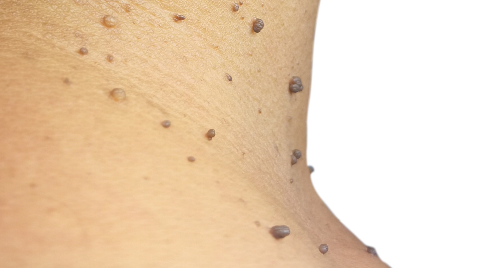 Skin Tag Removal