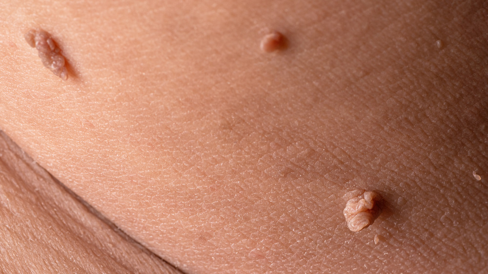 Close-up of skin tags on skin 
