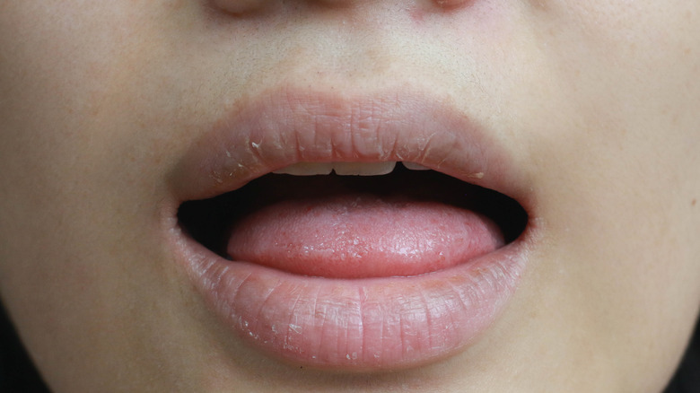 Open mouth with dry lips