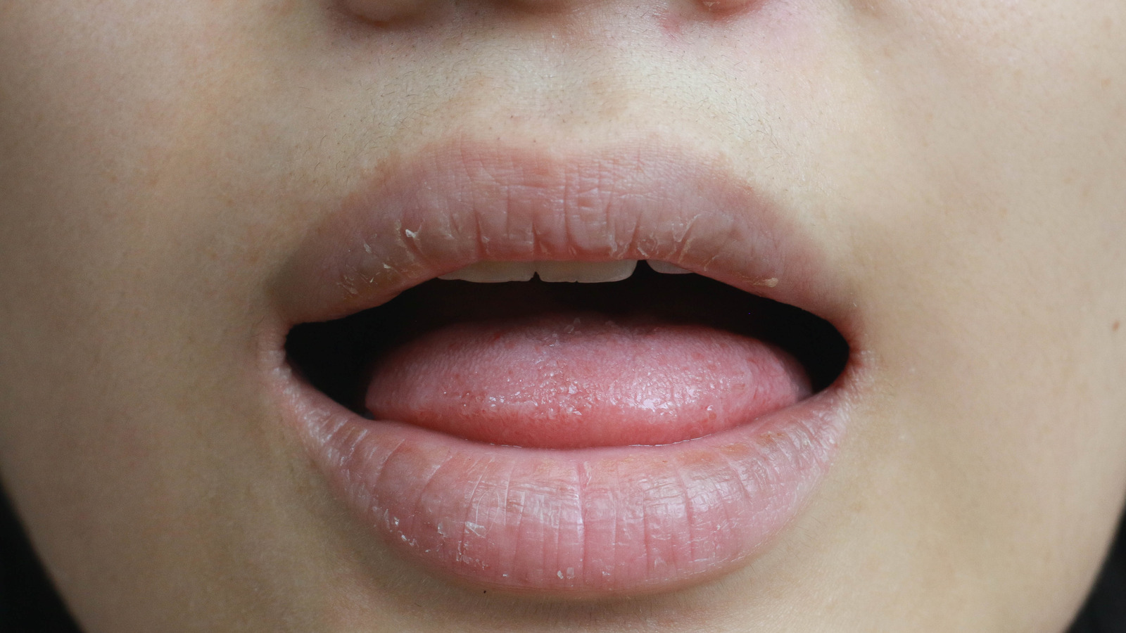What Risk Factors Can Lead To Dry Mouth?