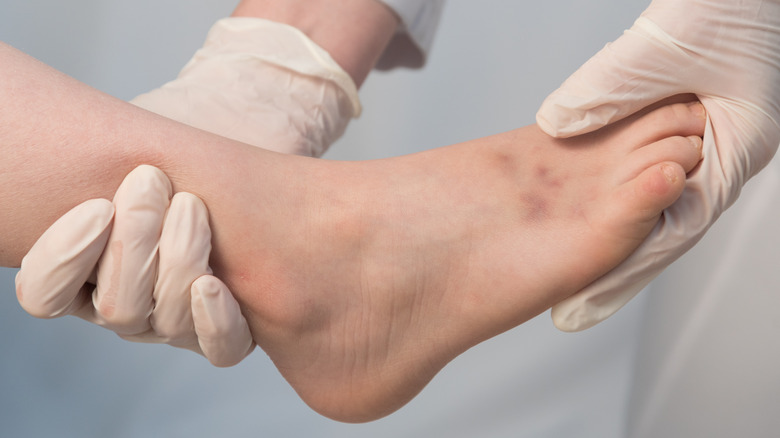 Doctor looking at bruises on a foot