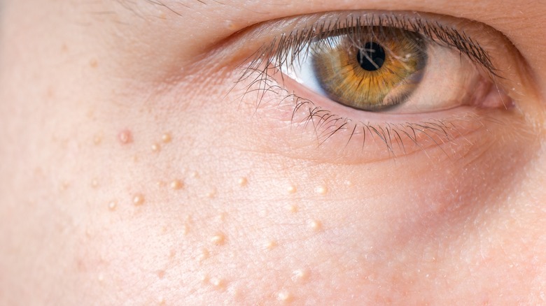 close-up of eye with milia close to it