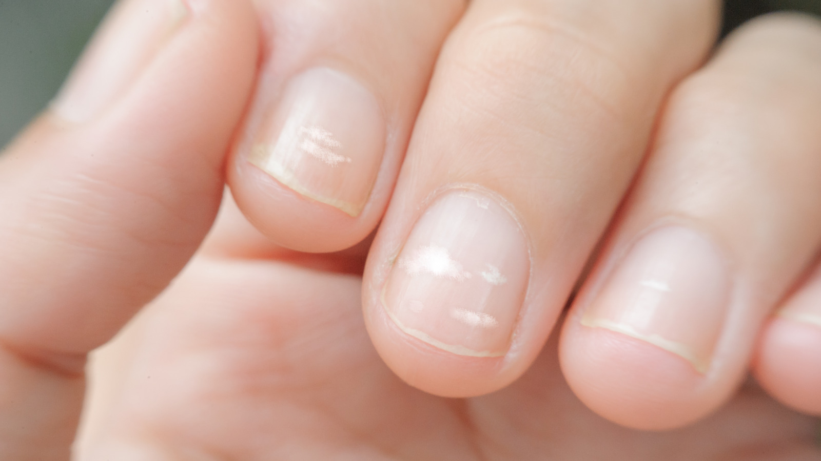 Do the white spots on some of my nails indicate a deficiency? - Quora