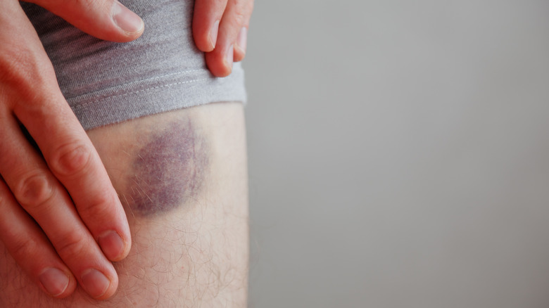 A bruise on someone's leg