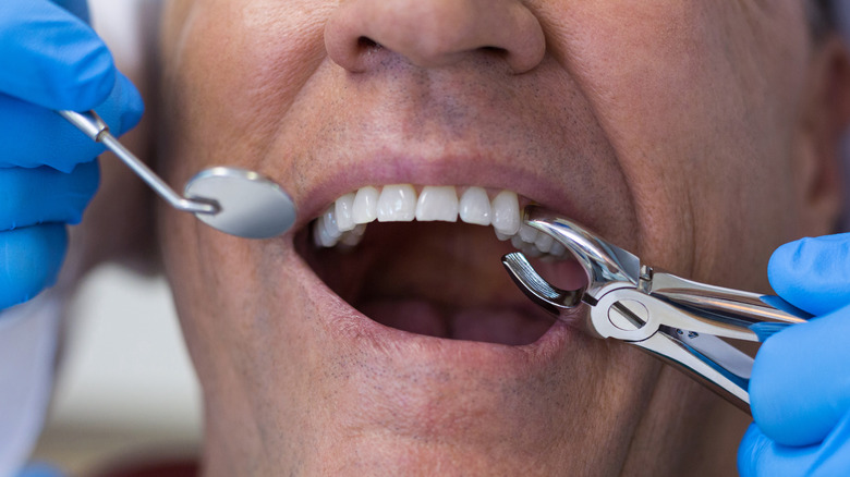 dentist preparing to extract tooth