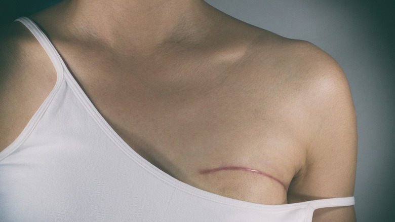woman with mastectomy scar