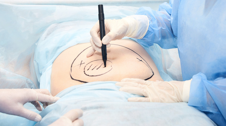surgeon marking stomach for tummy tuck
