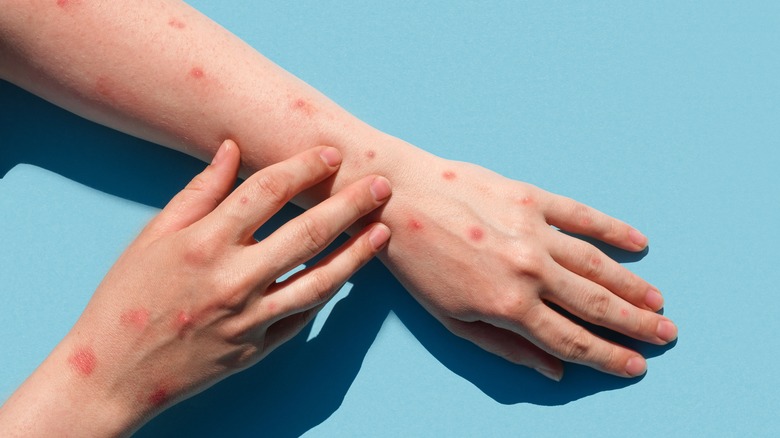 white female with monkeypox symptoms on hands