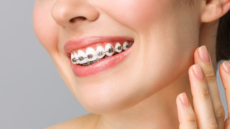 white woman smiling with braces on teeth