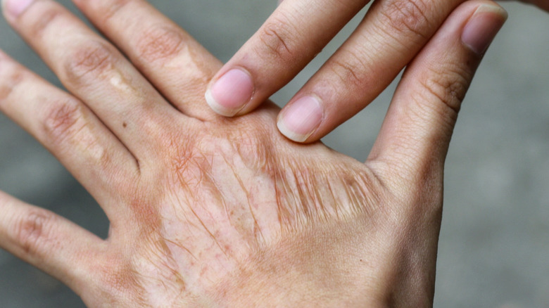 Burn scar on hand