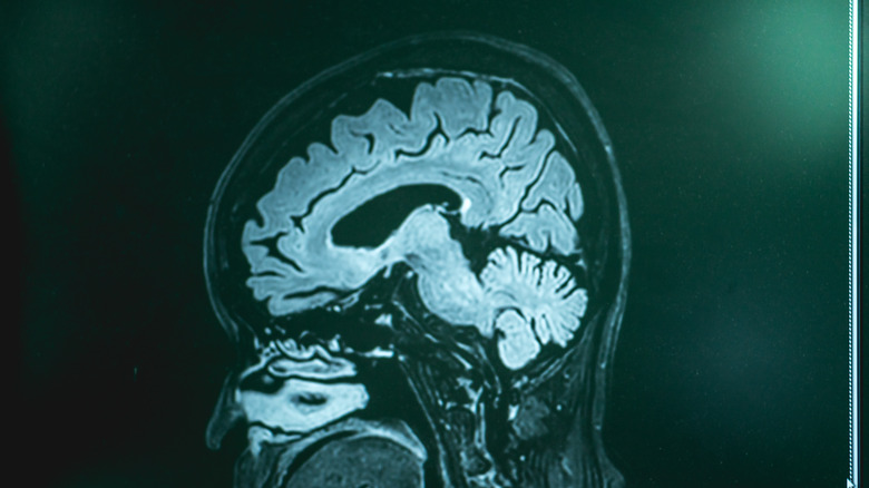 Frontotemporal dementia 