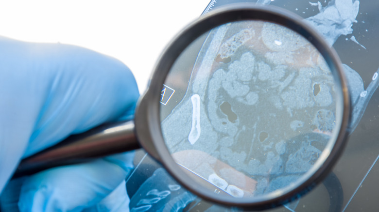 Magnifying glass over an MRI of the large and small intestines