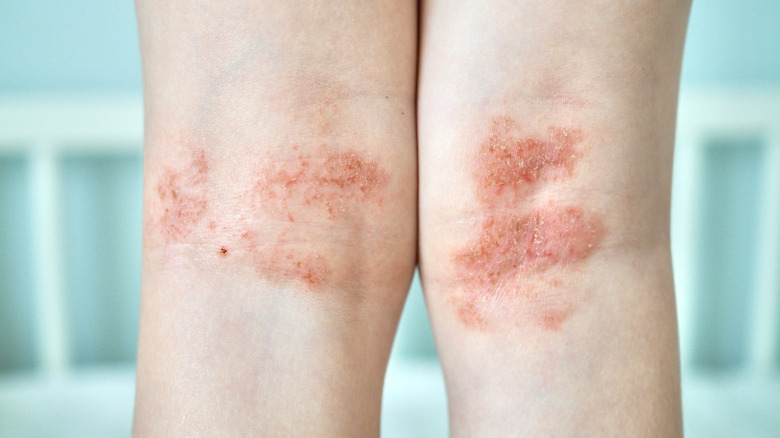 Eczema on back of child's legs