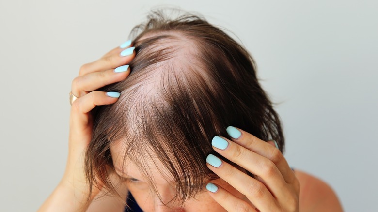 hair thinning on woman's scalp