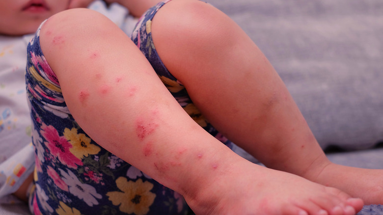 close-up of the legs of a child with tomato-sized rash