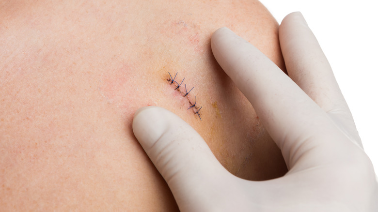 Close up of doctor's hands checking stitches