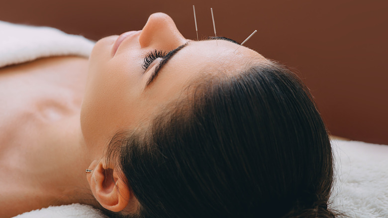 forehead acupuncture
