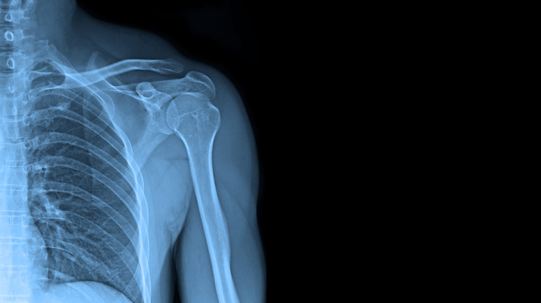 X-ray of shoulder