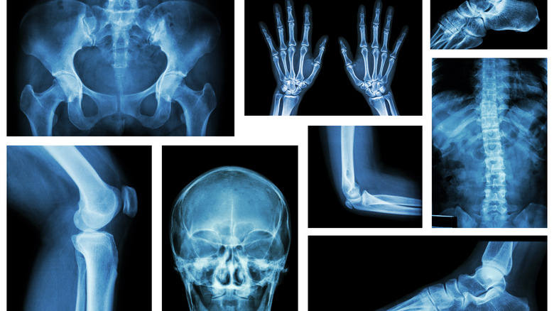 Xrays of bones