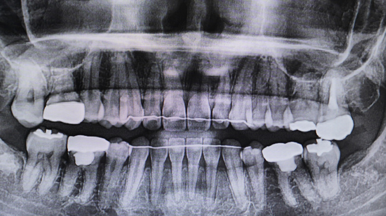Xray of permanent retainers