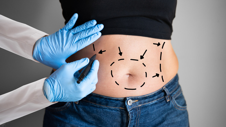 A surgeon draws on someone's stomach for liposuction