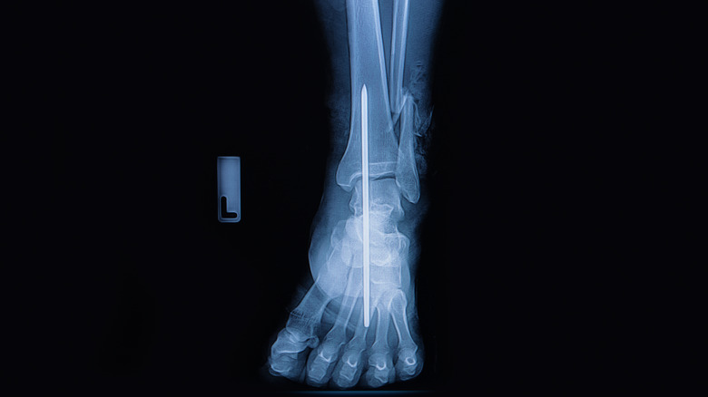 x-ray of metal rod in ankle