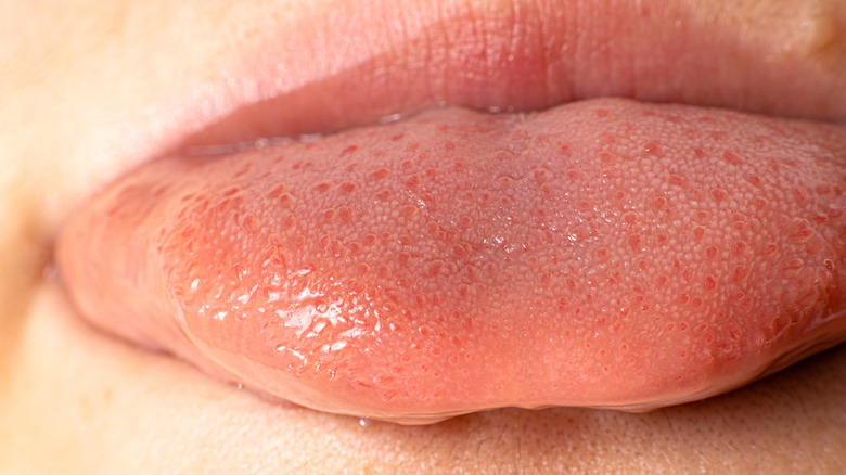 Swollen Taste Buds: Causes, Diagnosis, And Treatment