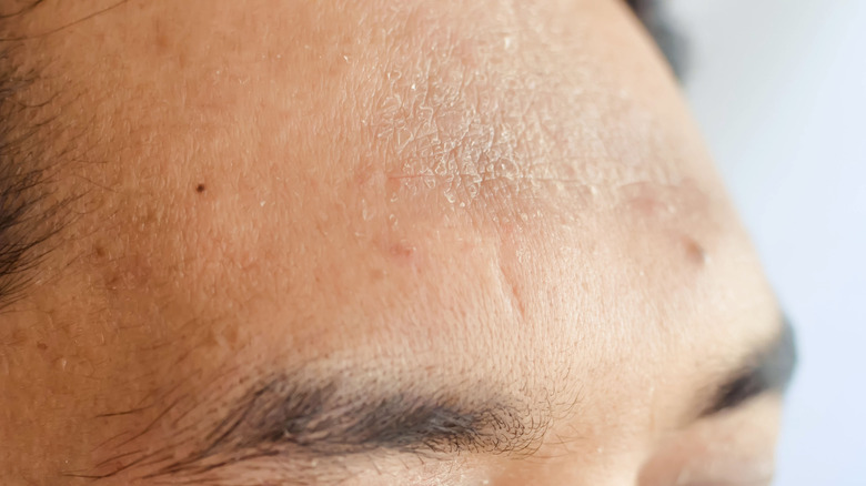 dull, flaky skin