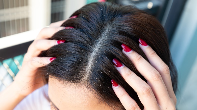 Woman with dandruff in hair