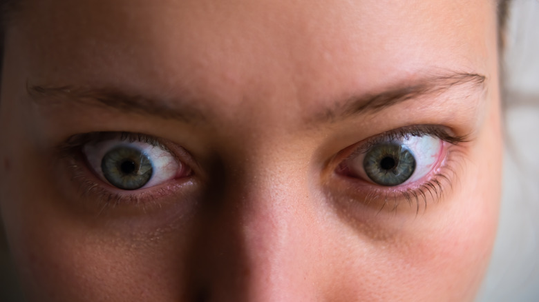 woman with bulging eyes