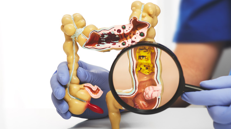 Colon model with tumor