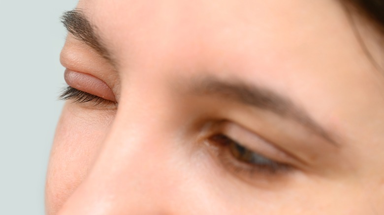 Woman with one swollen eyelid