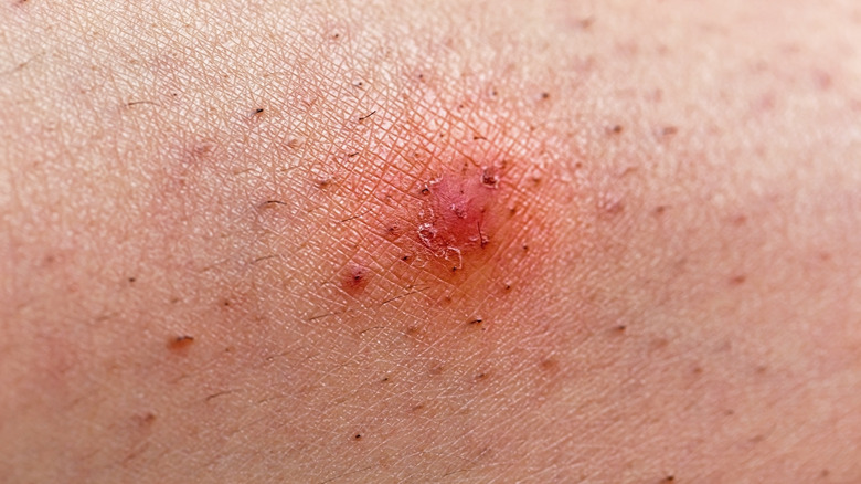 Red swollen ingrown hair