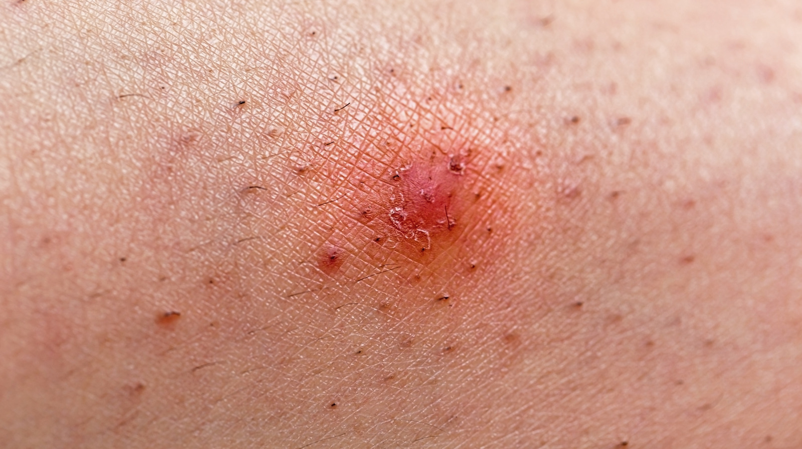 When To See Your Doctor About An Infected Ingrown Hair