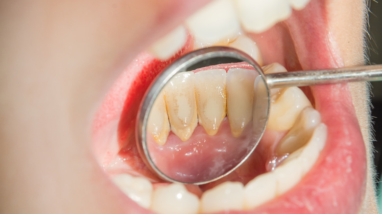 mirror on lower front teeth