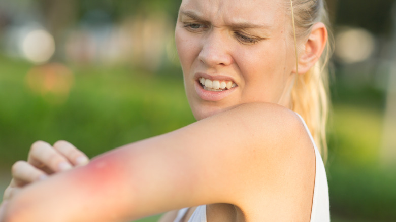 Mosquito bite on woman's arm