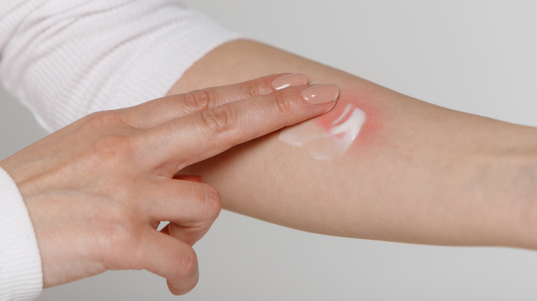 Woman applying cream to mosquito bite