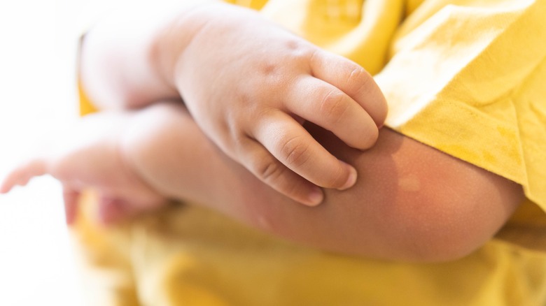 Kid scratching arm monkeypox