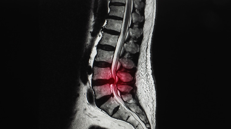 sciatica x-ray