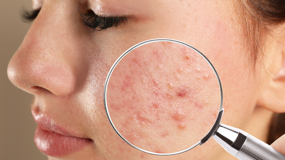 What Could Be Causing Your Acne?