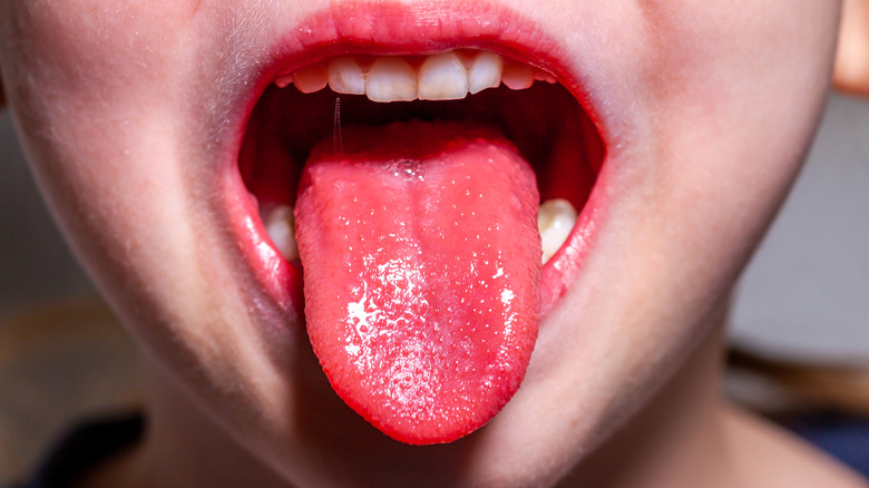A child showing his tongue with scarlet fever rash/strawberry tongue