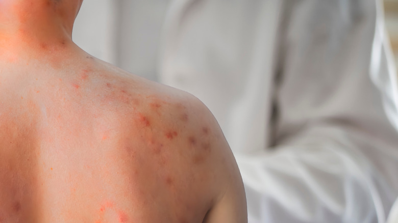 Measles rash presenting on a patient's back and shoulder