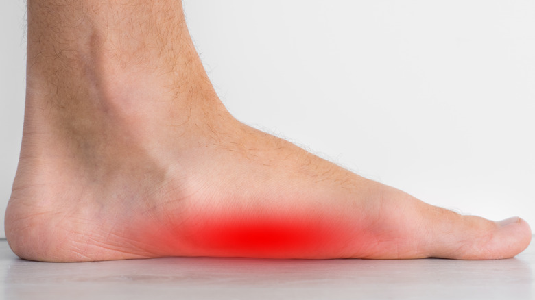 Flat foot against the floor with inflamed sole and no arch