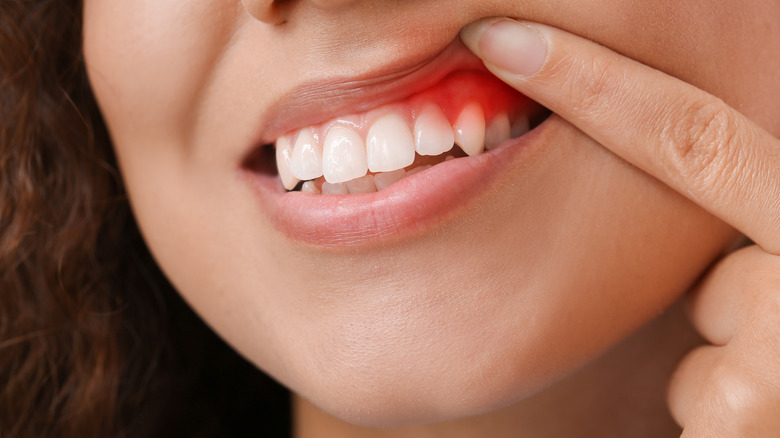 Woman with red, inflamed gums