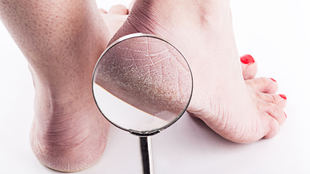 close-up of dry, cracked heel