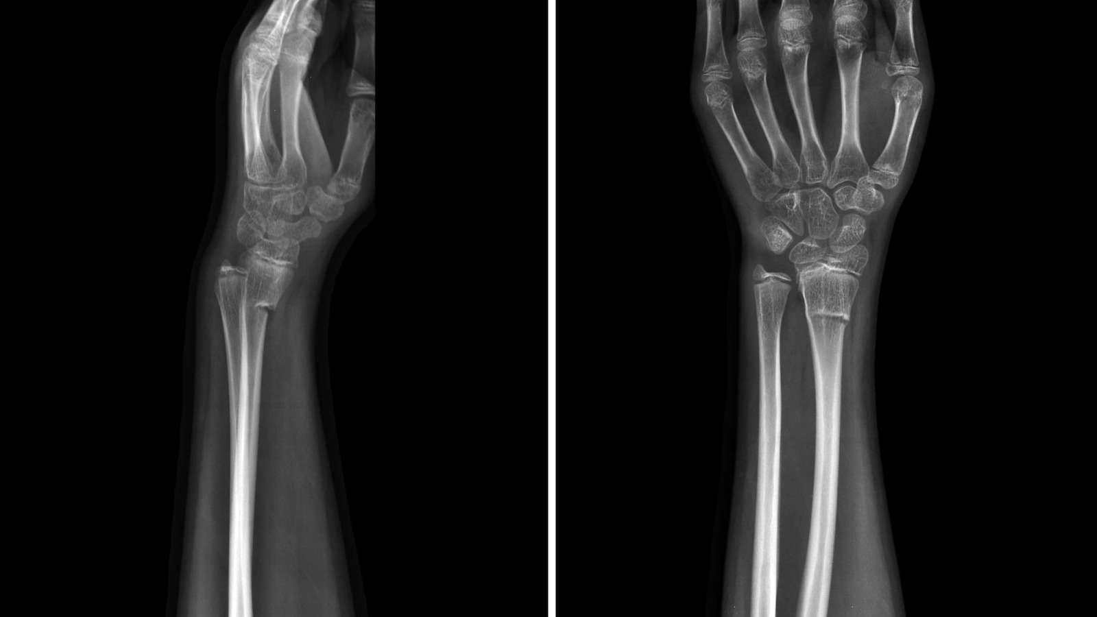 Why It Takes Longer To Heal Broken Bones As An Adult