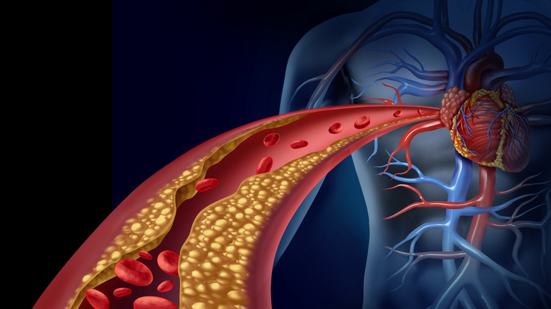 Diagram of partially blocked artery