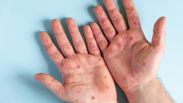 hands with monkeypox bumps