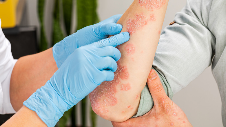 Gloved hand examining patient's arm with eczema outbreak